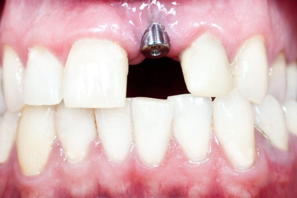 co zamiast implantu